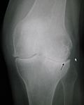 Arthritis is a common cause of posterior knee pain