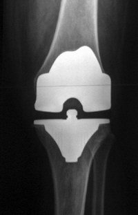 knee replacements operations total surgery common arthritis