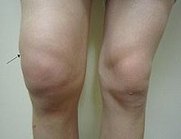 Swollen Knee: Causes, Diagnosis & Treatment