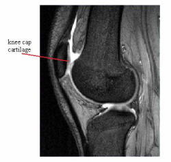 Mri Chondromalacia Patella