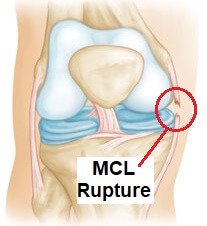 Common Knee Injuries: Symptoms, Diagnosis & Treatment
