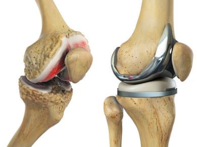 Total Knee Replacement Recovery What To Expect Knee Pain Explained