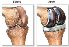 Osteoarthritis Knee Pain