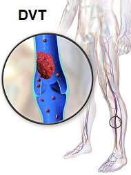 Leg clots (aka deep-vein thrombosis): an immediate and long-term health  hazard - Harvard Health