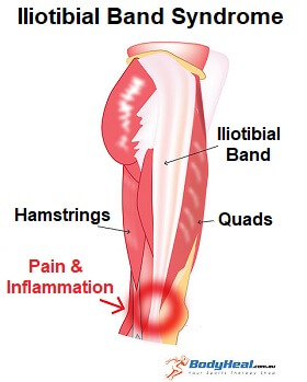 Knee Iliotibial Band Friction Syndrome After Total Knee
