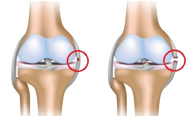What is a Medial Collateral Ligament (MCL) Knee Injury?