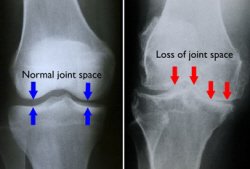 Arthritis in the Knee: Causes, Symptoms & Treatment