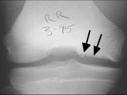 Osteochondritis Dissecans: Symptoms & Treatment - Knee Pain Explained