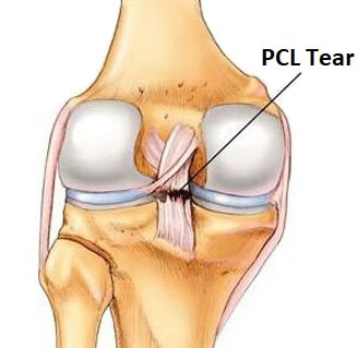 PCL INJURIES: WHAT HAPPENS AND WHAT TREATMENT OPTIONS ARE, 53% OFF