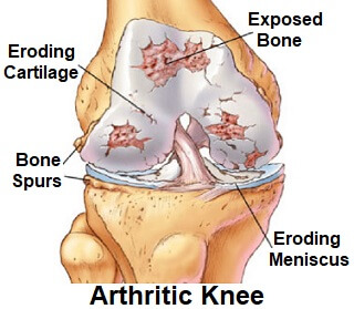 Knee and Popping: & Treatment - Knee Pain Explained