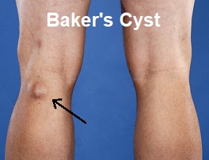 Bakers Cyst - Knee Pain Explained