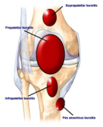 Knee Pain from Running: Diagnosis, Treatment & Prevention