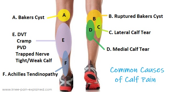 Calf Muscle Pain Causes Treatment Knee Pain Explained 2022 