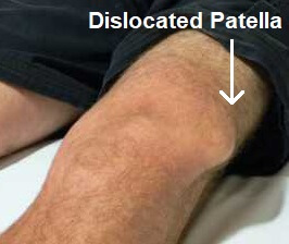 displaced kneecap symptoms