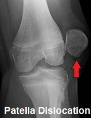 Dislocated Patella (Kneecap): Causes & Treatment - Knee Pain Explained