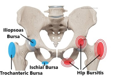 Knee Bursitis: Symptoms, Diagnosis & Treatment - Knee Pain Explained