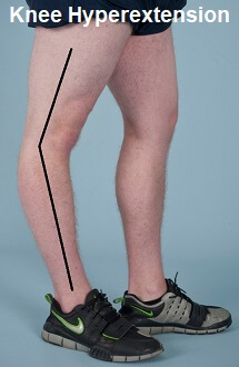What is the other name for hyperextended knee?