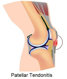 Patellar Tendonitis (Jumpers Knee): Symptoms, Diagnosis & Treatment