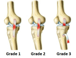 Knee Ligament Injury, Cause and Recovery