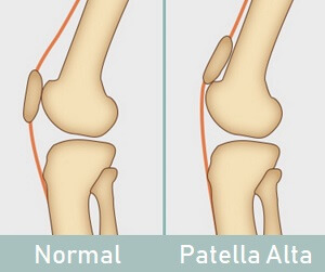 Knee Braces for Patella Alta 