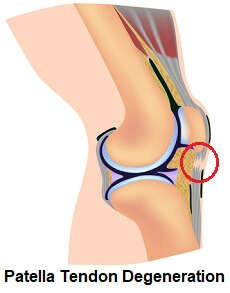 https://www.knee-pain-explained.com/images/patella-tendonitis-degeneration.jpg