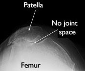 Patellofemoral Arthritis: Diagnosis, Causes & Treatment