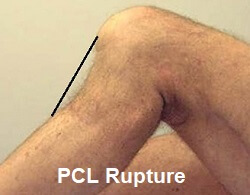 Knee Injuries Affecting the Back