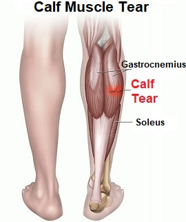 pain from calf to heel