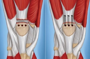 https://www.knee-pain-explained.com/images/ruptured-quadriceps-tendon-surgery.jpg