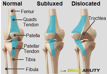 dislodged kneecap