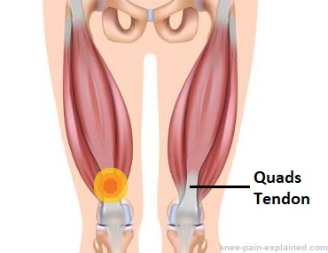 Severe Upper Leg Pain  10 Causes for Extreme Pain in Upper Leg