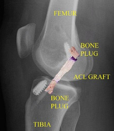 Problems After ACL Surgery - Knee Pain Explained