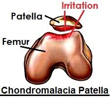 Chondromalacia Patella: Symptoms, Diagnosis & Treatment