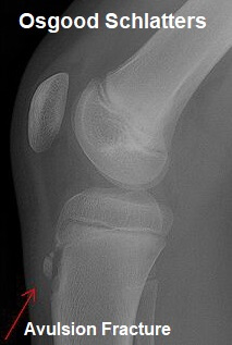 Osgood Schlatter Disease: Symptoms, Diagnosis & Treatment