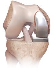 Common Problems after Knee Replacement - Knee Pain Explained